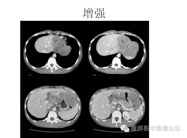 【病例】肝细胞型肝癌1例CT影像表现
