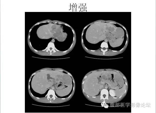 【病例】肝细胞型肝癌1例CT影像表现