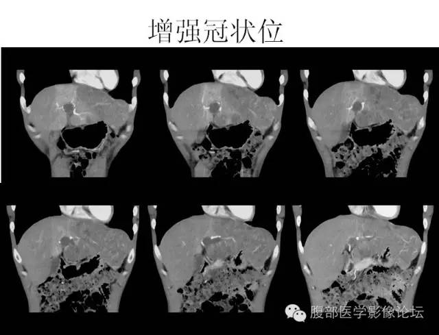 【病例】肝细胞型肝癌1例CT影像表现