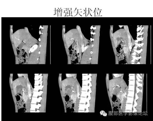 【病例】肝细胞型肝癌1例CT影像表现