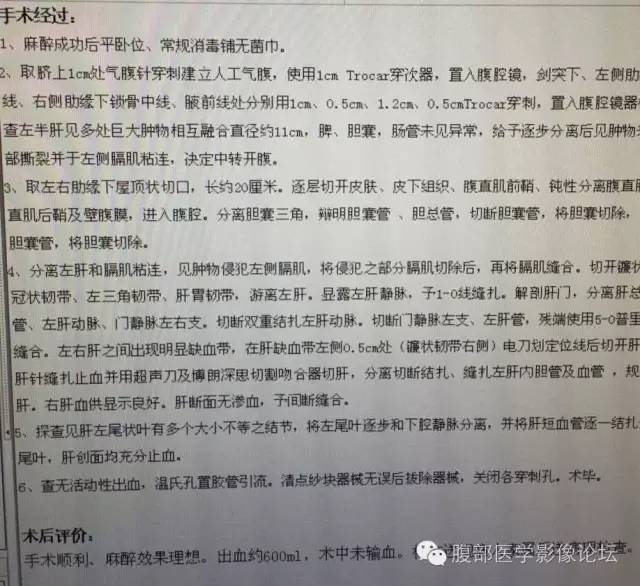 【病例】肝细胞型肝癌1例CT影像表现