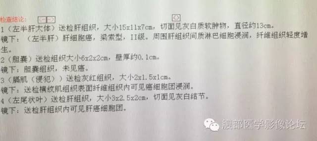 【病例】肝细胞型肝癌1例CT影像表现