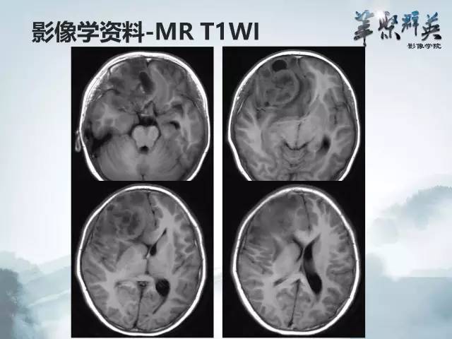 【病例】颅内好大一团钙化——右额叶室管膜瘤1例CT及MR影像表现
