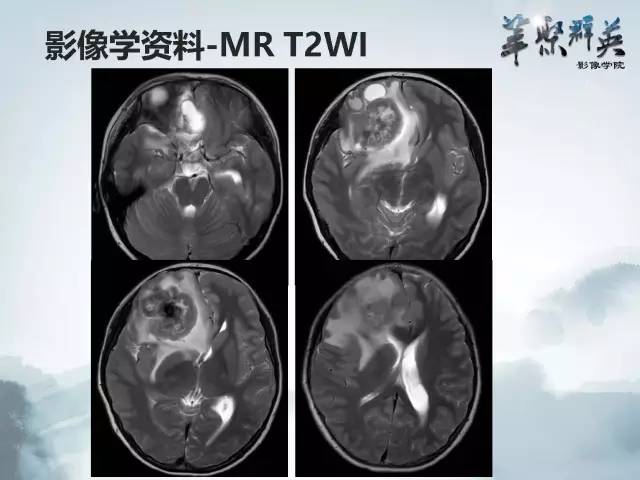 【病例】颅内好大一团钙化——右额叶室管膜瘤1例CT及MR影像表现