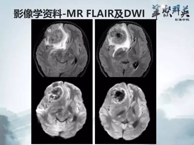 【病例】颅内好大一团钙化——右额叶室管膜瘤1例CT及MR影像表现
