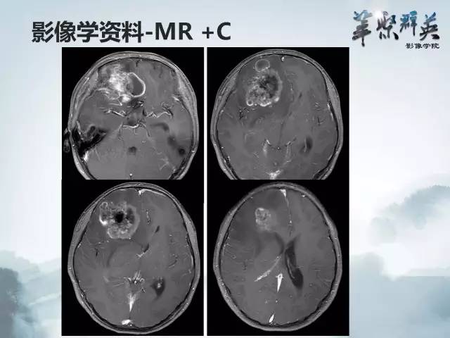 【病例】颅内好大一团钙化——右额叶室管膜瘤1例CT及MR影像表现