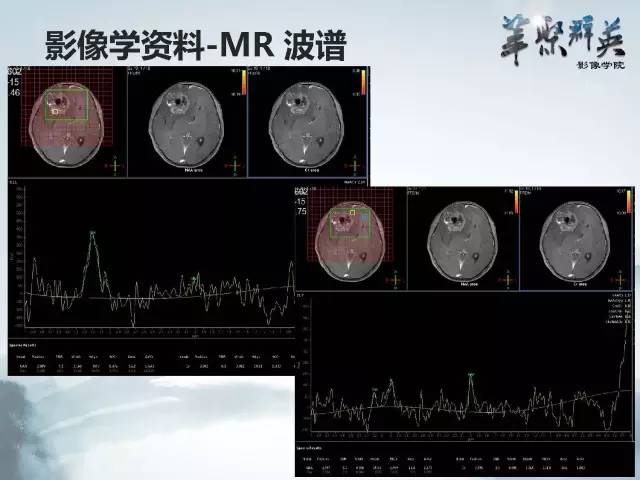 【病例】颅内好大一团钙化——右额叶室管膜瘤1例CT及MR影像表现