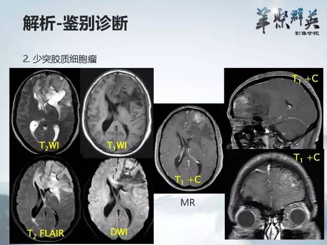 【病例】颅内好大一团钙化——右额叶室管膜瘤1例CT及MR影像表现