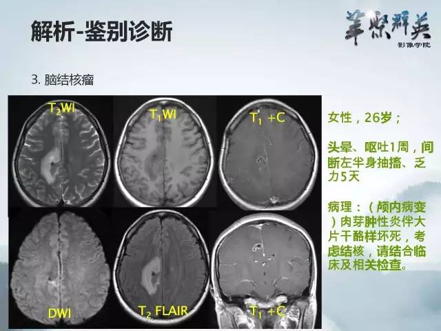 【病例】颅内好大一团钙化——右额叶室管膜瘤1例CT及MR影像表现