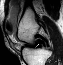 "双后交叉韧带征"，这个征象提示啥？
