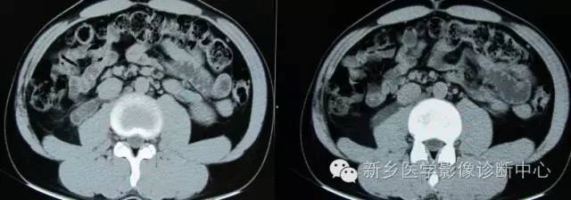 下腔静脉后输尿管