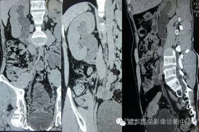 下腔静脉后输尿管 下腔静脉后输尿管