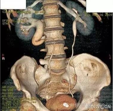 下腔静脉后输尿管 下腔静脉后输尿管