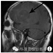 【病例】胶质细胞增生症1例MR影像表现 【病例】胶质细胞增生症1例MR影像表现