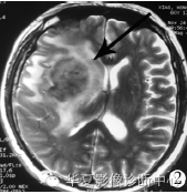 【病例】胶质细胞增生症1例MR影像表现