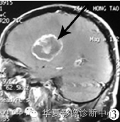 【病例】胶质细胞增生症1例MR影像表现 【病例】胶质细胞增生症1例MR影像表现