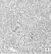【病例】胶质细胞增生症1例MR影像表现 【病例】胶质细胞增生症1例MR影像表现