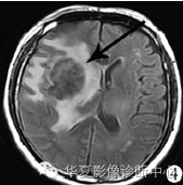 【病例】胶质细胞增生症1例MR影像表现 【病例】胶质细胞增生症1例MR影像表现