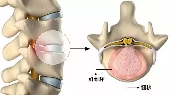 椎间盘早晚竟然有这么多的变化