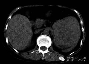 【病例】左肾嗜酸细胞腺瘤1例CT影像表现 【病例】左肾嗜酸细胞腺瘤1例CT影像表现