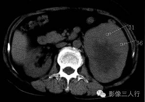 【病例】左肾嗜酸细胞腺瘤1例CT影像表现 【病例】左肾嗜酸细胞腺瘤1例CT影像表现