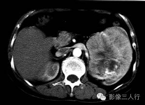 【病例】左肾嗜酸细胞腺瘤1例CT影像表现 【病例】左肾嗜酸细胞腺瘤1例CT影像表现