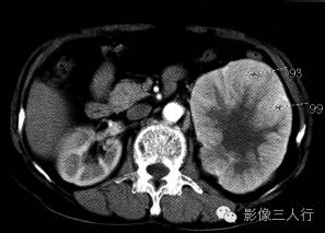 【病例】左肾嗜酸细胞腺瘤1例CT影像表现