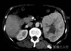 【病例】左肾嗜酸细胞腺瘤1例CT影像表现 【病例】左肾嗜酸细胞腺瘤1例CT影像表现