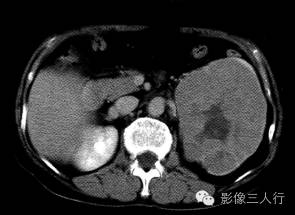 【病例】左肾嗜酸细胞腺瘤1例CT影像表现 【病例】左肾嗜酸细胞腺瘤1例CT影像表现