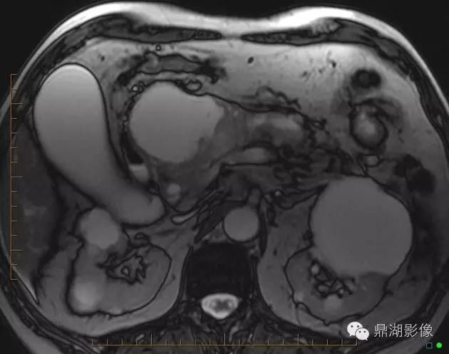 【病例】胰腺粘液性囊腺癌1例MR影像表现