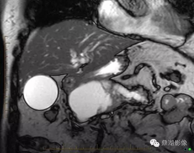 【病例】胰腺粘液性囊腺癌1例MR影像表现 【病例】胰腺粘液性囊腺癌1例MR影像表现
