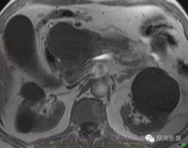【病例】胰腺粘液性囊腺癌1例MR影像表现 【病例】胰腺粘液性囊腺癌1例MR影像表现