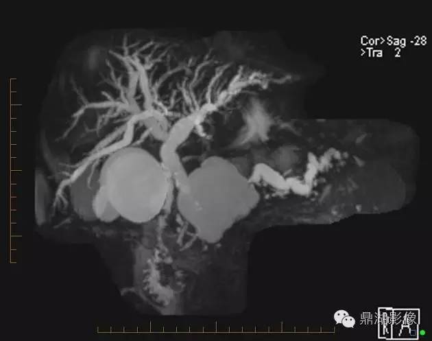 【病例】胰腺粘液性囊腺癌1例MR影像表现 【病例】胰腺粘液性囊腺癌1例MR影像表现