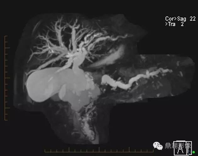 【病例】胰腺粘液性囊腺癌1例MR影像表现 【病例】胰腺粘液性囊腺癌1例MR影像表现