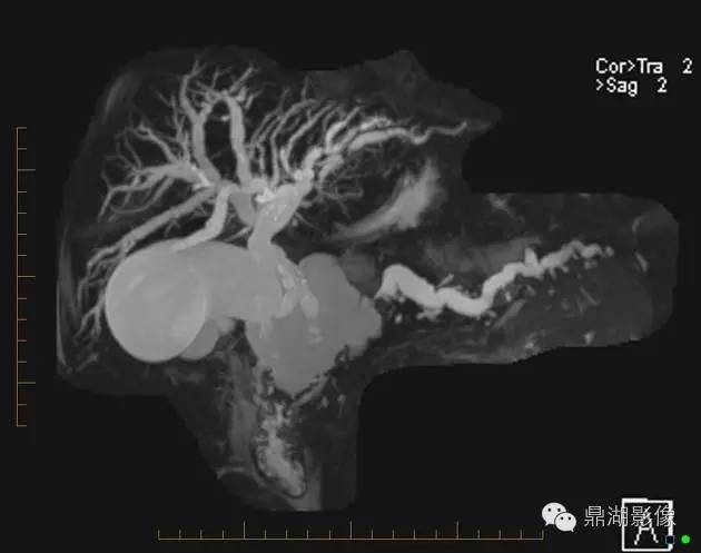 【病例】胰腺粘液性囊腺癌1例MR影像表现 【病例】胰腺粘液性囊腺癌1例MR影像表现