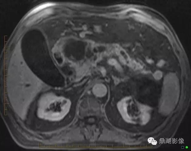 【病例】胰腺粘液性囊腺癌1例MR影像表现 【病例】胰腺粘液性囊腺癌1例MR影像表现