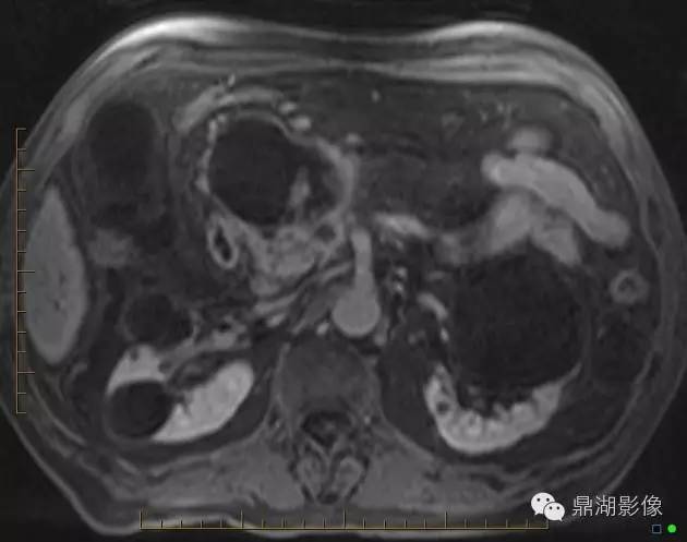 【病例】胰腺粘液性囊腺癌1例MR影像表现 【病例】胰腺粘液性囊腺癌1例MR影像表现