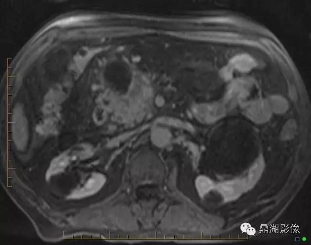 【病例】胰腺粘液性囊腺癌1例MR影像表现 【病例】胰腺粘液性囊腺癌1例MR影像表现