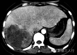 【病例】肝未分化胚胎性肉瘤1例CT影像表现