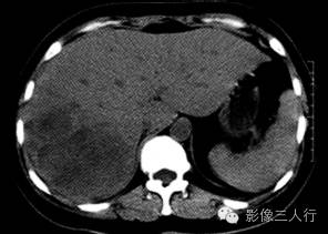 【病例】肝未分化胚胎性肉瘤1例CT影像表现
