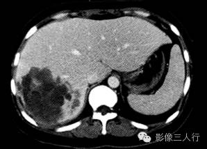 【病例】肝未分化胚胎性肉瘤1例CT影像表现
