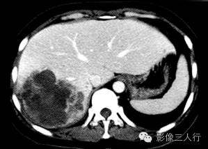 【病例】肝未分化胚胎性肉瘤1例CT影像表现