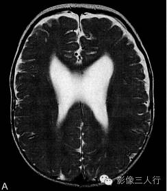 【病例】先天性单腔脑畸形1例MR影像表现