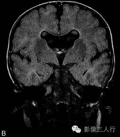 【病例】先天性单腔脑畸形1例MR影像表现 【病例】先天性单腔脑畸形1例MR影像表现