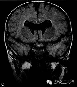 【病例】先天性单腔脑畸形1例MR影像表现 【病例】先天性单腔脑畸形1例MR影像表现