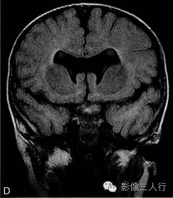 【病例】先天性单腔脑畸形1例MR影像表现 【病例】先天性单腔脑畸形1例MR影像表现