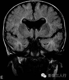 【病例】先天性单腔脑畸形1例MR影像表现 【病例】先天性单腔脑畸形1例MR影像表现