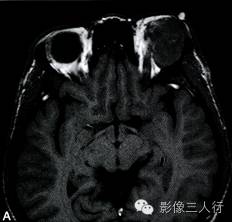 【病例】泪腺黏液表皮样癌1例MR影像表现分析 【病例】泪腺黏液表皮样癌1例MR影像表现分析