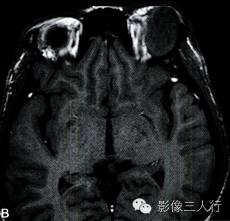 【病例】泪腺黏液表皮样癌1例MR影像表现分析 【病例】泪腺黏液表皮样癌1例MR影像表现分析