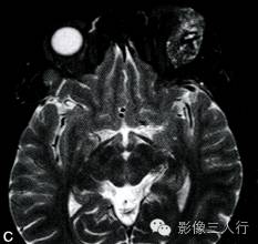 【病例】泪腺黏液表皮样癌1例MR影像表现分析